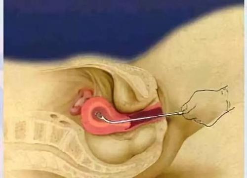 辣妈手记丨手术流产和药物流产哪个损伤更小?会影响以后生育吗?