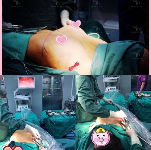 假体隆胸后的护理