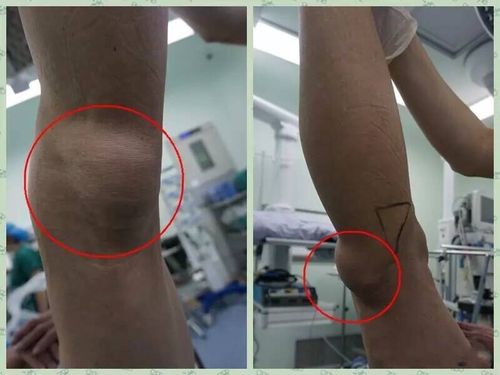 膝关节镜下微创治疗腘窝囊肿