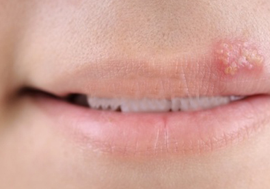 揭秘口唇单纯疱疹 口唇疱疹是由什么引起的