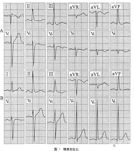 [心电图分析] 大家请看,一例与众不同的右位心心电图!