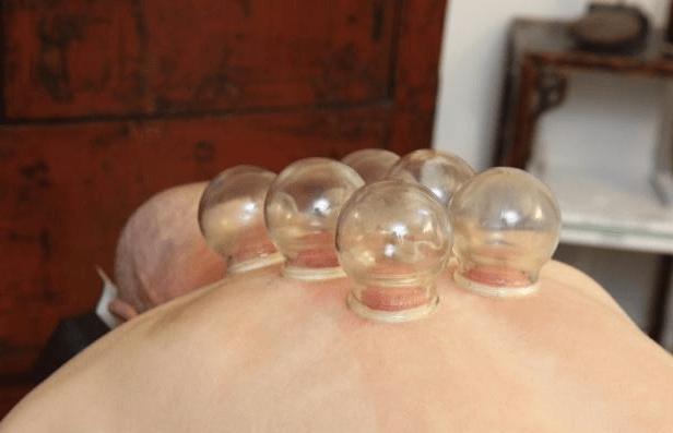 原创拔火罐时,后背吸出的瘀血,真的是毒素吗?医生说出了大实话