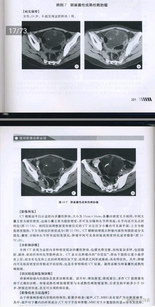 影像ct病例:盆腔内卵巢畸胎瘤分享