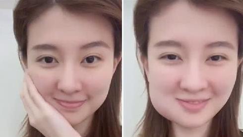 拔智齿堪比整容乔欣方脸变v脸网友牙医安排上