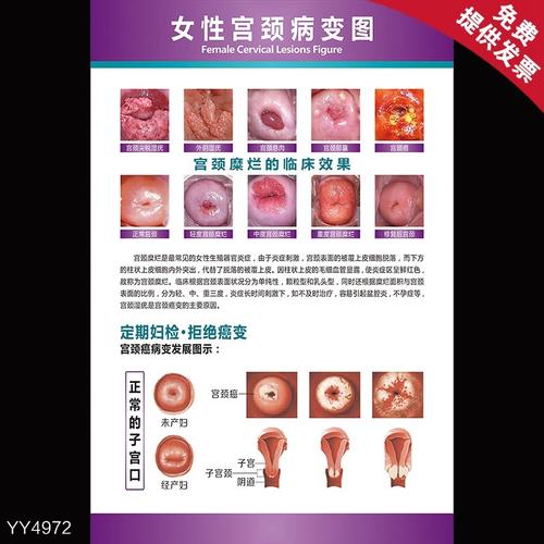 妇科科室女性健康病变宫颈宣传海报挂图贴画