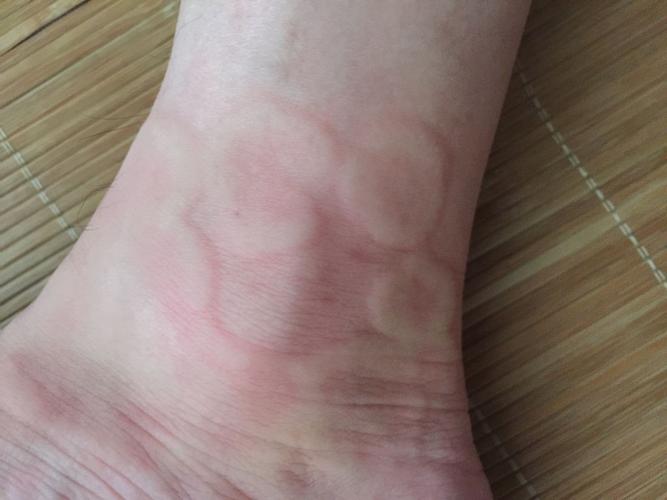 不知道是不是被虫咬了,附图,四肢都很痒,怎么解决?