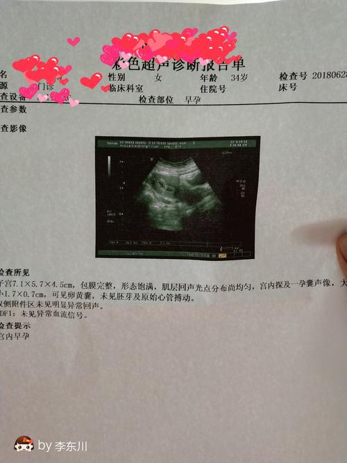 四十天一个孕囊医生说像两个是双胞胎吗