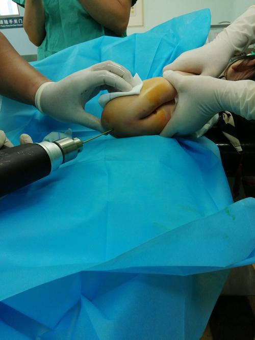 经皮微创克氏针固定