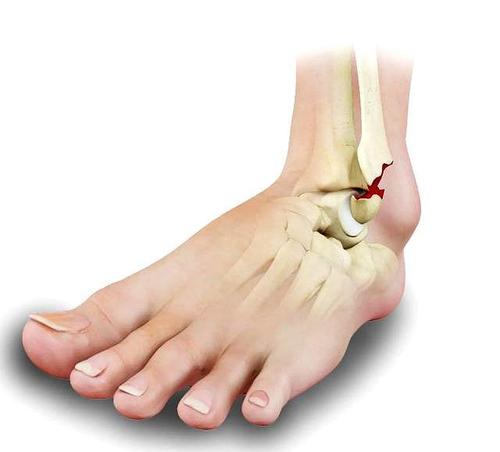 踝关节骨折45天,能开始步行训练吗?哪些细节要注意?