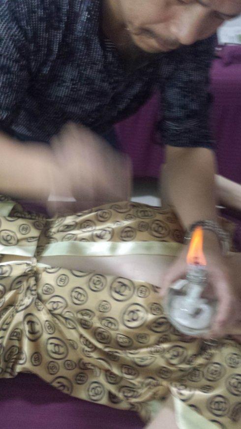 针灸治疗乳腺增生