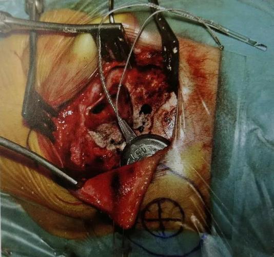 人工耳蜗那些事儿人工耳蜗手术流程详解上