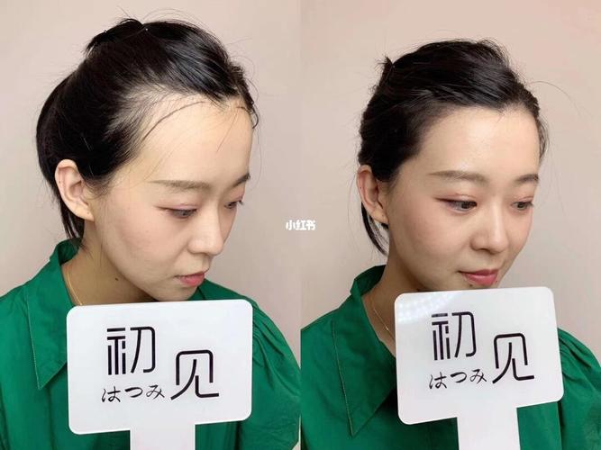 发际线_生发_半永久纹发际线_美妆_医美整形