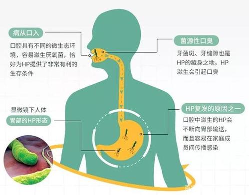 幽门螺旋杆菌危害示意图(图来自网络)