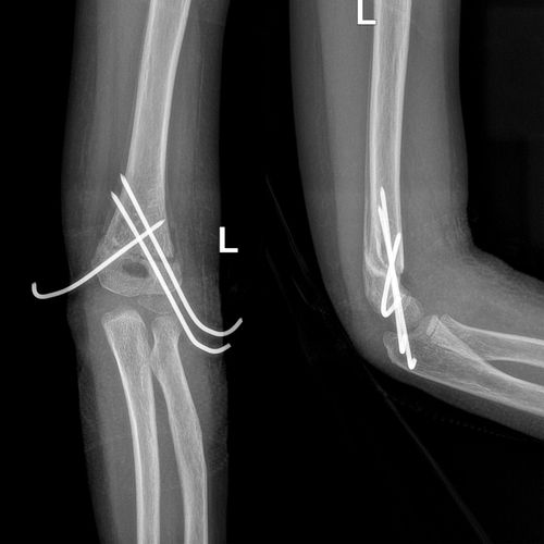 术后3周骨折对位良好,大量骨痂生长.