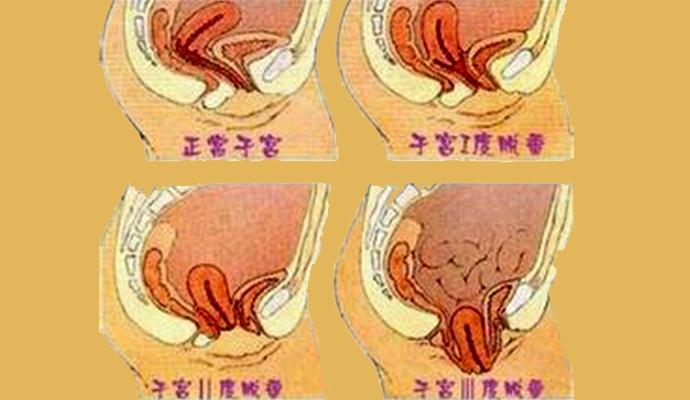 子宫脱垂,到底有多可怕?