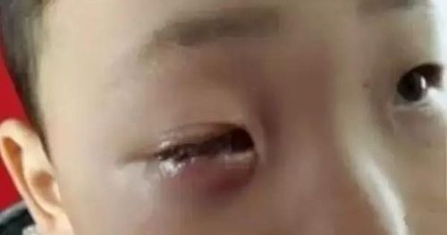 8岁小男孩在客厅玩耍时眼睛竟然一瞬间「溶解失明」,医生询问原因后