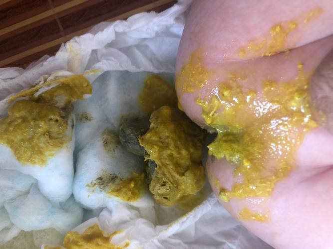 请问各位这种大便是乳糖不耐受还是消化不良