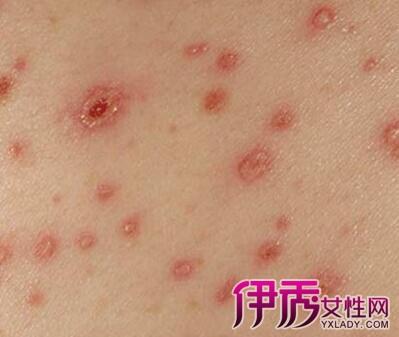 【图】艾滋病的特征有哪些 如何体现出来