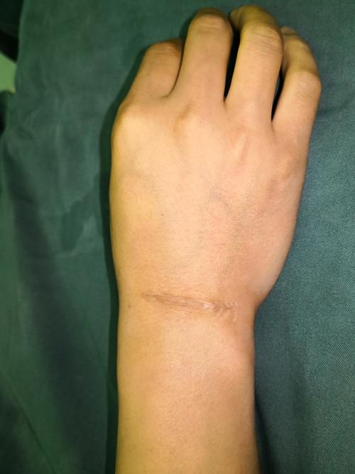 彻底切除加美容缝合手术治疗手腕部常见肿物:腱鞘囊肿