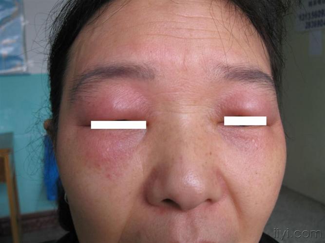 看图识病血管性水肿过敏性