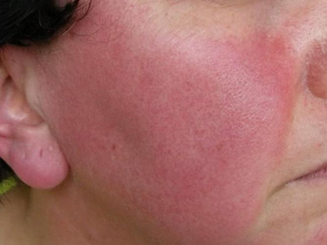 红斑毛细血管扩张型玫瑰痤疮怎么治疗?