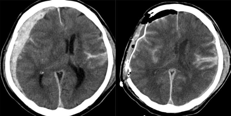 急诊头部ct扫描显示,右侧急性硬膜下血肿,脑挫伤和蛛网膜下腔出血