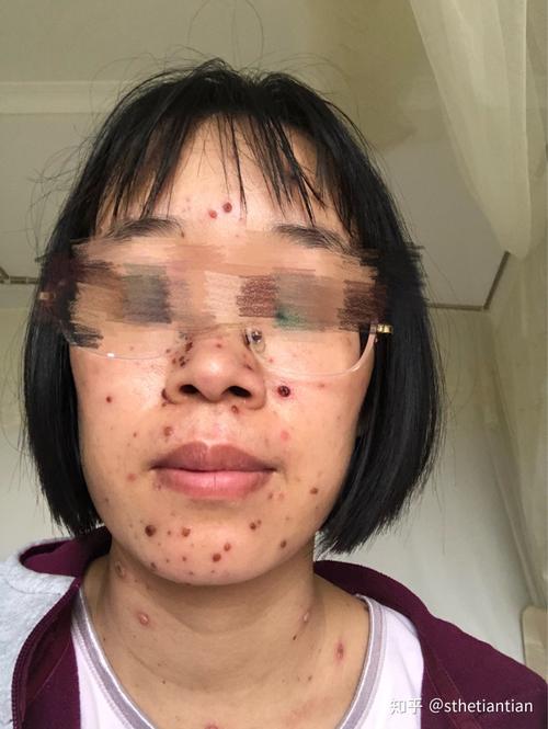 成人长水痘 - 知乎