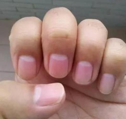 指甲月牙白的这些状况,表示很容易肾虚,男性肾虚对照自查一下!