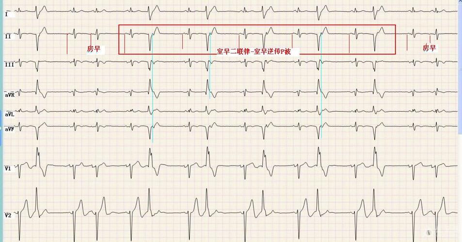 天马流星吹 -房房早-室早二联律.jpg