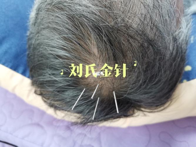 百会穴,四神聪穴_医疗健康_医疗方法