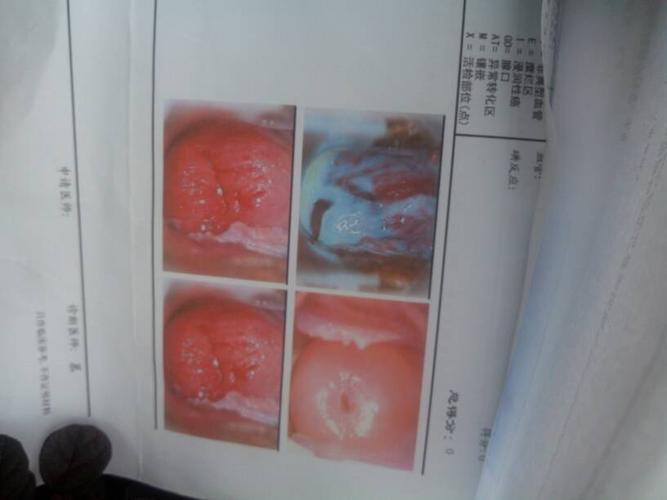 这个宫颈糜烂的严重吗? 几度