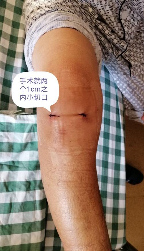 赣州市立医院骨科微创技术:关节镜手术(半月板损伤修复篇)