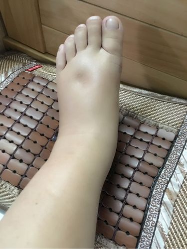 下肢水肿求安慰;有没有一样的姐妹!