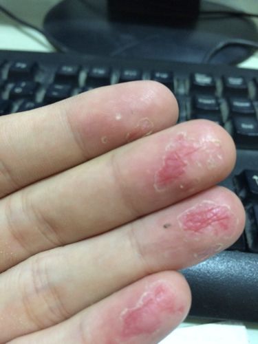 手指脱皮,是什麼症状?需要擦什麼药?