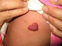 婴儿血管瘤会长大吗?