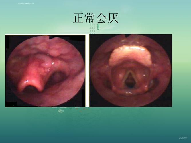 急性会厌炎的护理