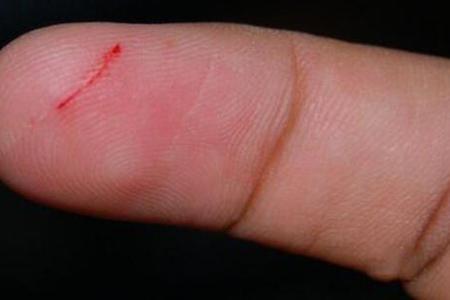 手指上的小伤口,为什么那么疼?