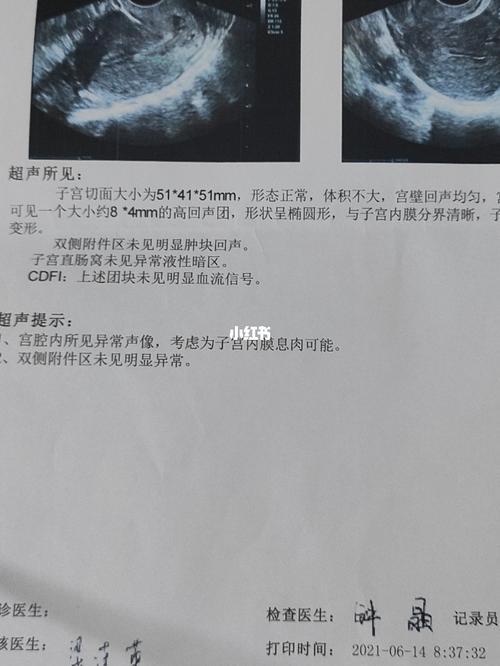 2021年6月14号查出子宫内膜息肉_子宫_子宫内膜息肉_医疗健康_医疗