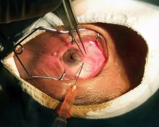 康燕可翼状胬肉手术全过程