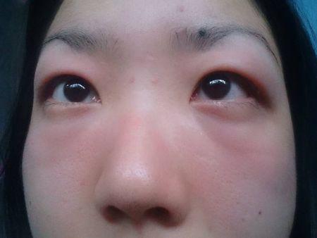 眼睛浮肿是什么原因