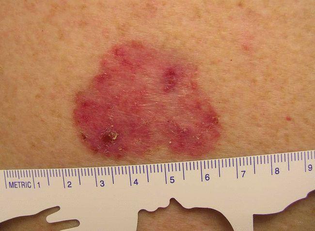 鲍温病的病程很缓慢,若在身上发现一直不能消退的淡红色或暗红色的斑