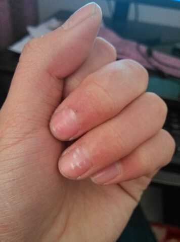 1,宝宝如果经常有肚子痛的现象,那可能是因为有蛔虫,所以反义在指甲上