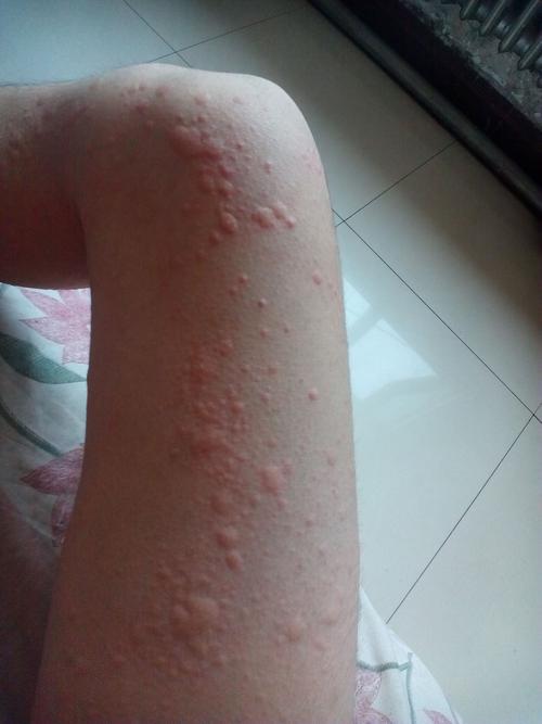 过敏了身上起了好多红疙瘩,上身疙瘩少,但是一片一片红的,下身疙瘩多