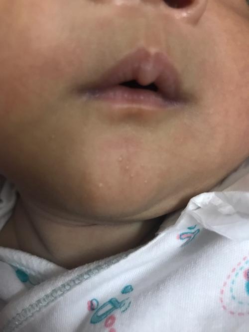 宝宝下巴长了一个一个是不是奶渍啊,用婴宝擦了了没擦掉,有时候