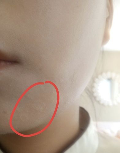 清明踏青,得了桃花癣怎么办?