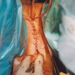 最美变性人陈述变性手术经历