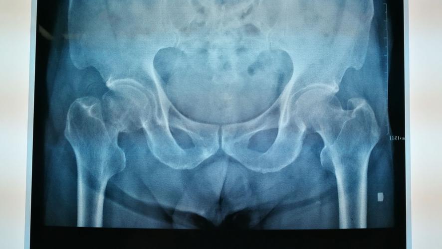 77岁男性股骨颈骨折术前x光片.
