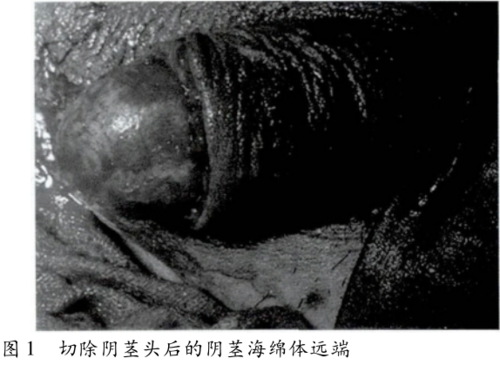 高分化鳞状细胞癌一例