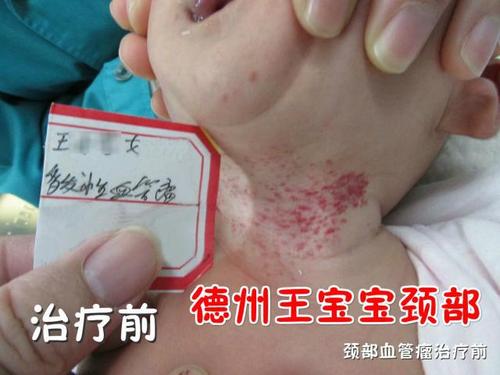 脖子上长血管瘤是什么病?原来3秒宝妈可以读懂