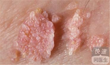 菜花型尖锐湿疣的患病原因 主要与不洁性生活有关